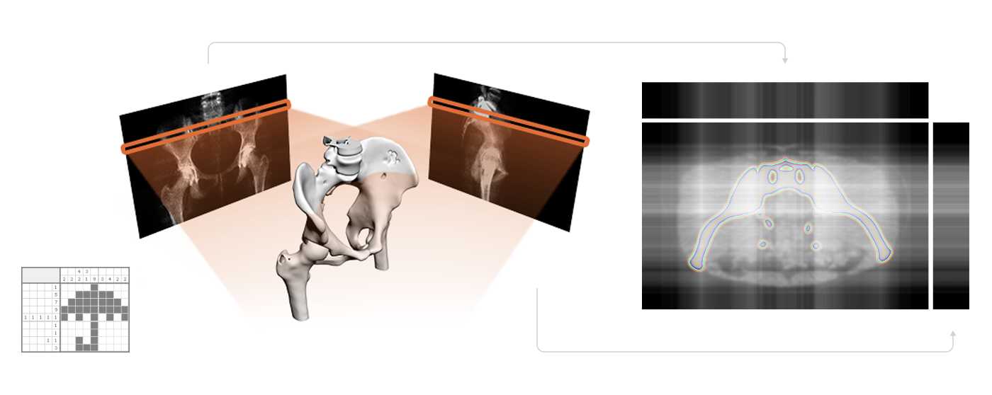 X-ray Stereogrammetry (RSA) Powered by Machine Learning as an Alternative to CT